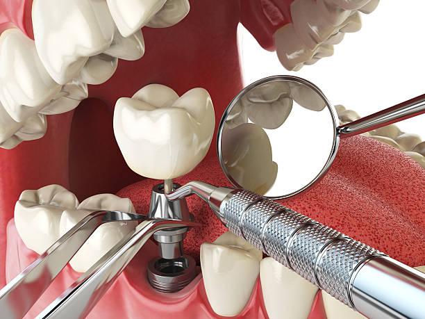Best Emergency Root Canal Treatment in Mcallen, TX